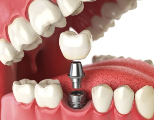 Dental Implants: Permanent Tooth Replacement Solutions 